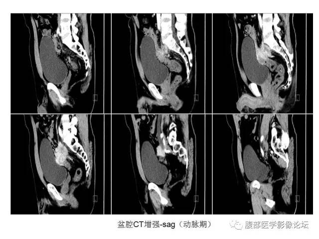 【病例】直肠乙状结肠交界处神经内分泌肿瘤1例CT