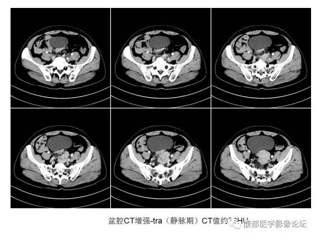 【病例】直肠乙状结肠交界处神经内分泌肿瘤1例CT