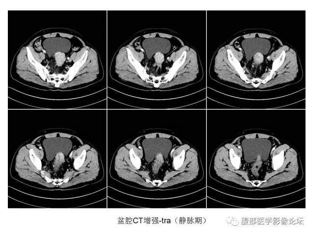 【病例】直肠乙状结肠交界处神经内分泌肿瘤1例CT
