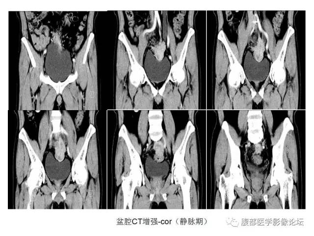 【病例】直肠乙状结肠交界处神经内分泌肿瘤1例CT