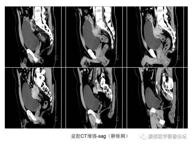 【病例】直肠乙状结肠交界处神经内分泌肿瘤1例CT