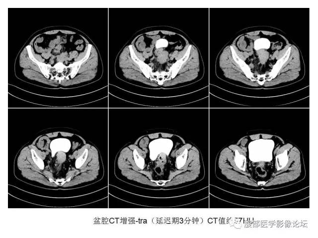 【病例】直肠乙状结肠交界处神经内分泌肿瘤1例CT