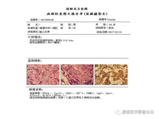 【病例】直肠乙状结肠交界处神经内分泌肿瘤1例CT