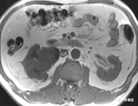 【病例】右肾盂癌1例MR影像诊断分析 【病例】右肾盂癌1例MR影像诊断分析