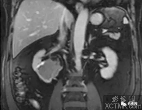 【病例】右肾盂癌1例MR影像诊断分析 【病例】右肾盂癌1例MR影像诊断分析