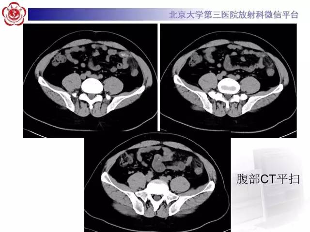 【病例】肠脂垂炎1例CT影像表现