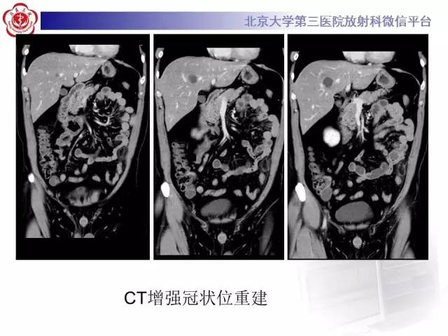 【病例】肠脂垂炎1例CT影像表现
