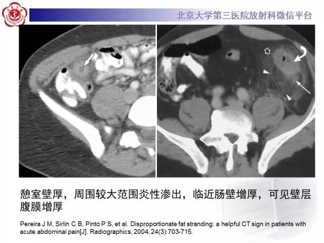 【病例】肠脂垂炎1例CT影像表现