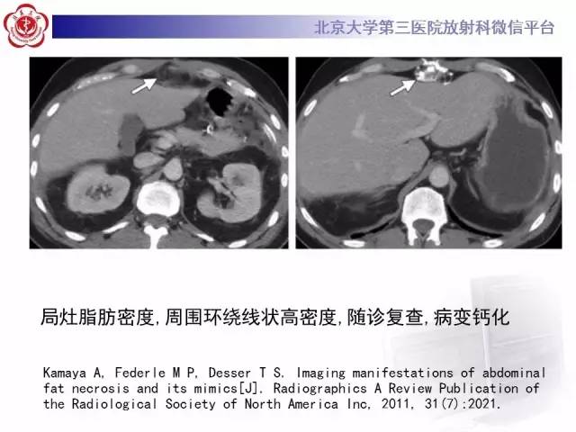 【病例】肠脂垂炎1例CT影像表现