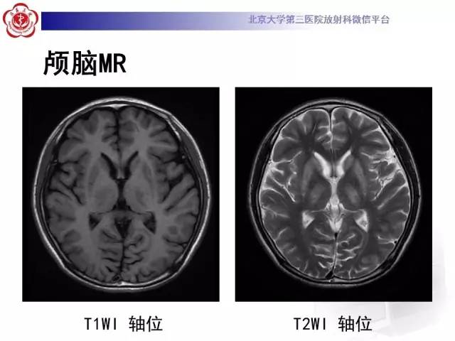 【病例】肝豆状核变性1例MR