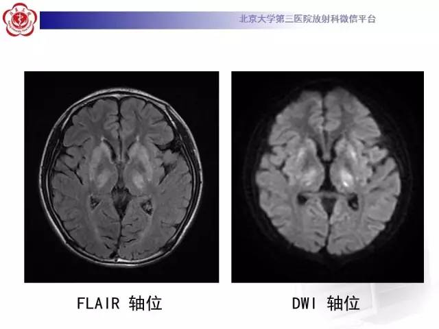 【病例】肝豆状核变性1例MR