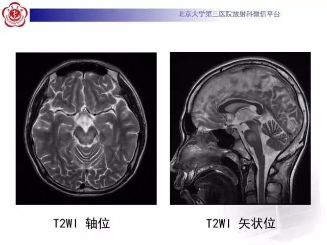 【病例】肝豆状核变性1例MR
