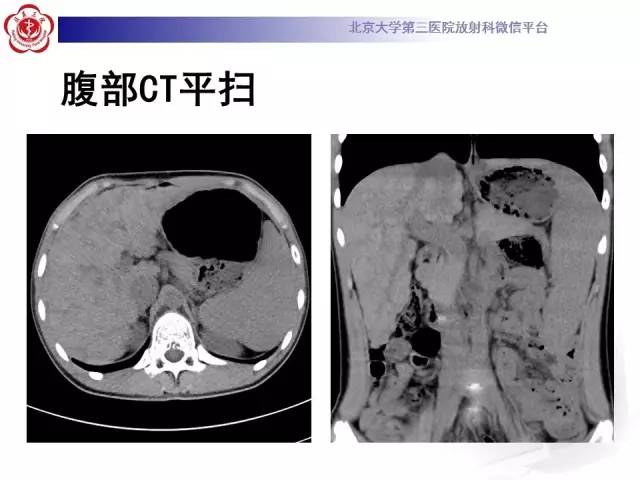 【病例】肝豆状核变性1例MR