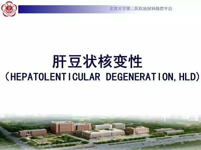 【病例】肝豆状核变性1例MR