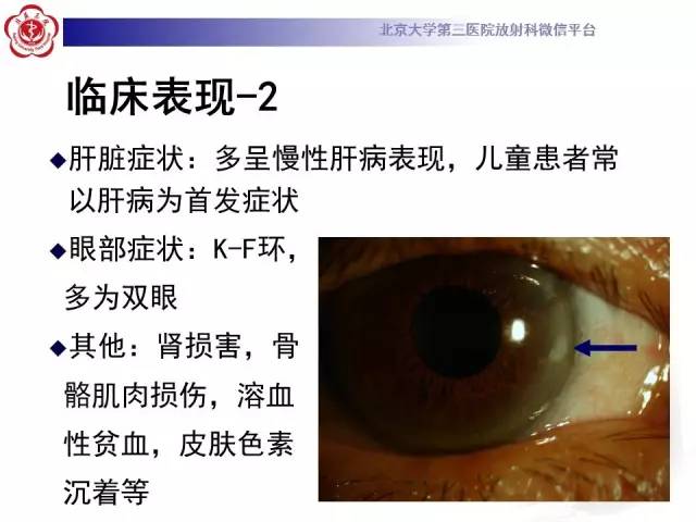 【病例】肝豆状核变性1例MR