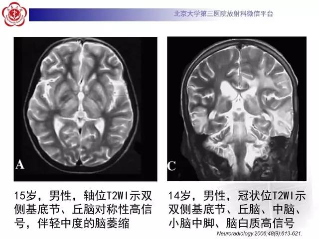 【病例】肝豆状核变性1例MR