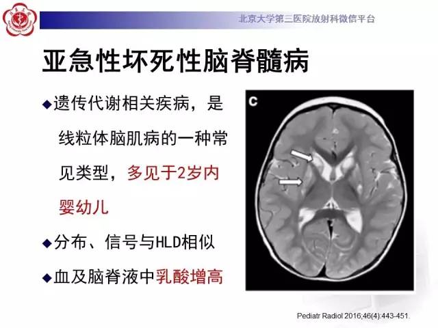 【病例】肝豆状核变性1例MR
