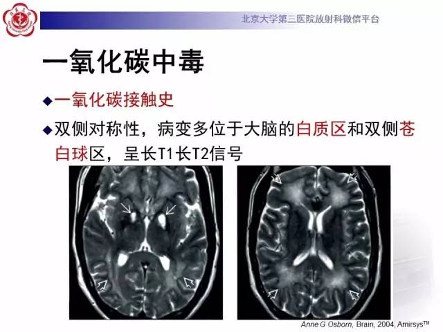 【病例】肝豆状核变性1例MR