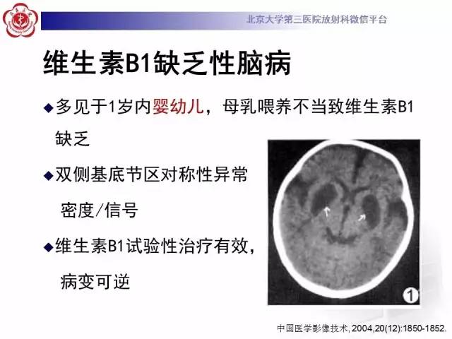 【病例】肝豆状核变性1例MR