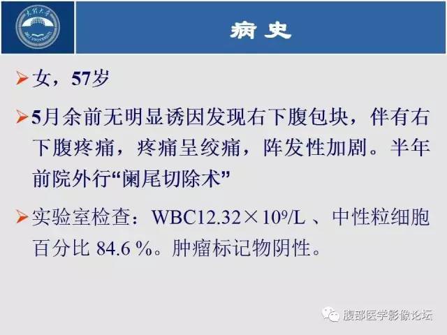 【病例】腹膜后平滑肌肉瘤1例CT影像表现 【病例】腹膜后平滑肌肉瘤1例CT影像表现