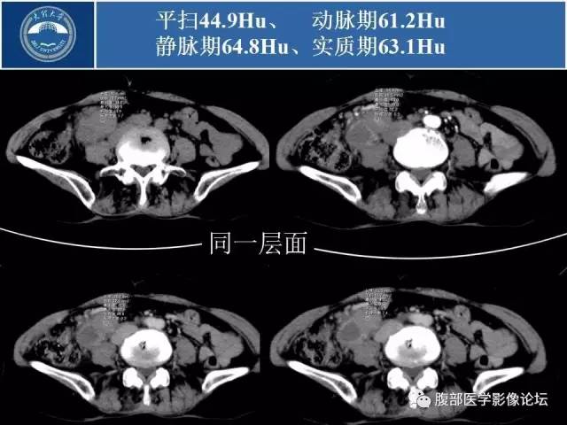 【病例】腹膜后平滑肌肉瘤1例CT影像表现 【病例】腹膜后平滑肌肉瘤1例CT影像表现