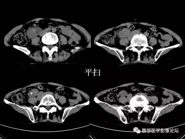 【病例】腹膜后平滑肌肉瘤1例CT影像表现 【病例】腹膜后平滑肌肉瘤1例CT影像表现