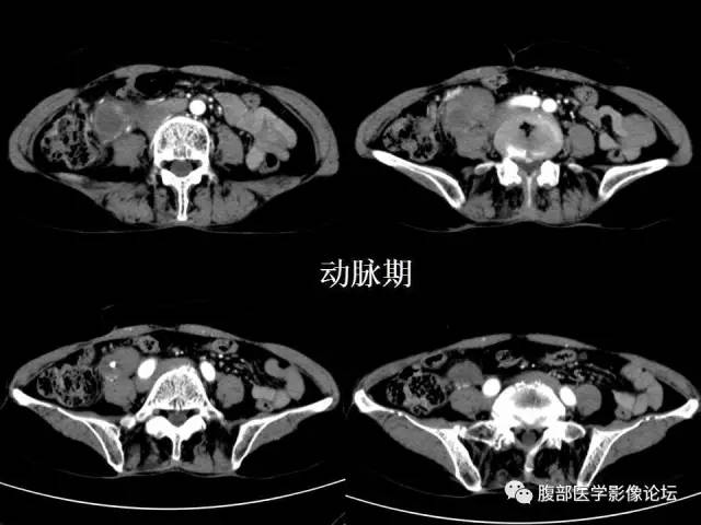 【病例】腹膜后平滑肌肉瘤1例CT影像表现 【病例】腹膜后平滑肌肉瘤1例CT影像表现