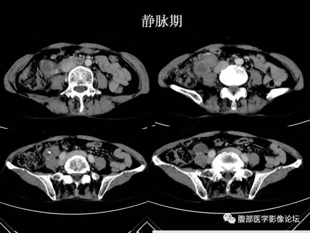 【病例】腹膜后平滑肌肉瘤1例CT影像表现 【病例】腹膜后平滑肌肉瘤1例CT影像表现