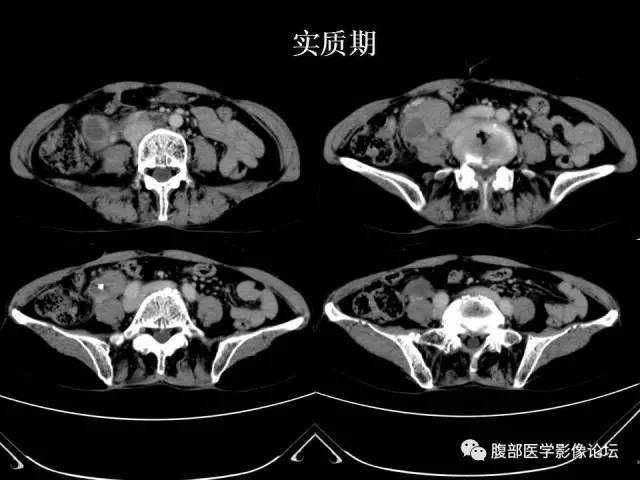 【病例】腹膜后平滑肌肉瘤1例CT影像表现 【病例】腹膜后平滑肌肉瘤1例CT影像表现