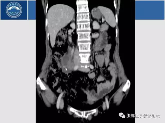【病例】腹膜后平滑肌肉瘤1例CT影像表现 【病例】腹膜后平滑肌肉瘤1例CT影像表现
