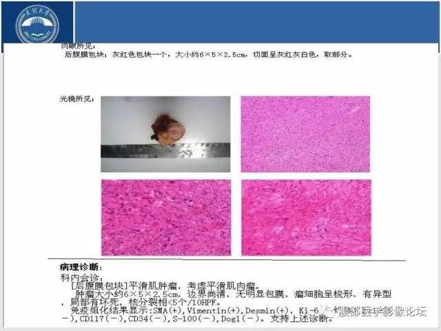 【病例】腹膜后平滑肌肉瘤1例CT影像表现 【病例】腹膜后平滑肌肉瘤1例CT影像表现