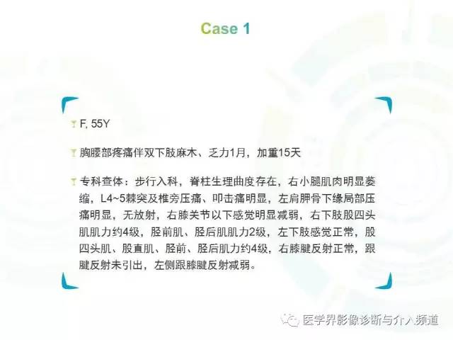 【病例】髓内星形细胞瘤1例MR影像表现