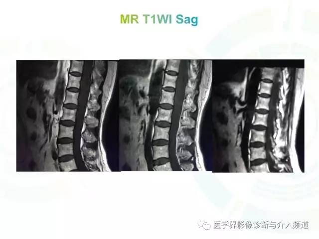【病例】髓内星形细胞瘤1例MR影像表现