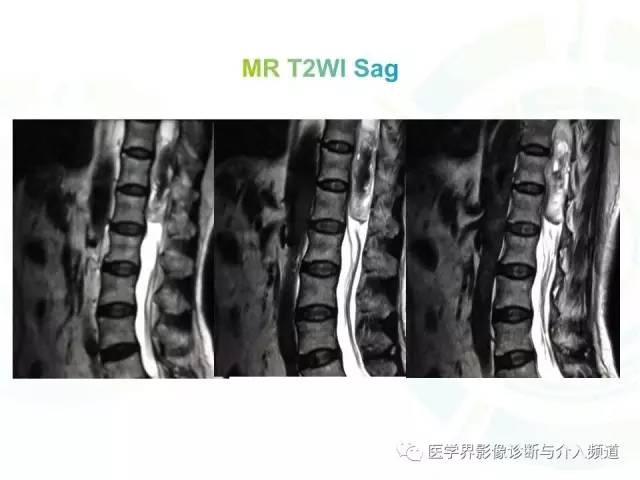 【病例】髓内星形细胞瘤1例MR影像表现