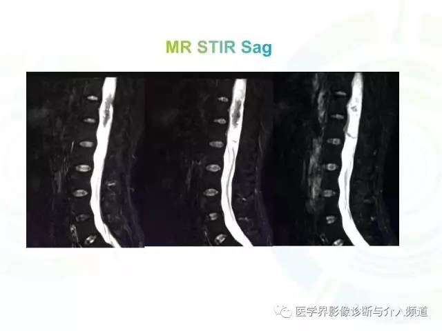 【病例】髓内星形细胞瘤1例MR影像表现