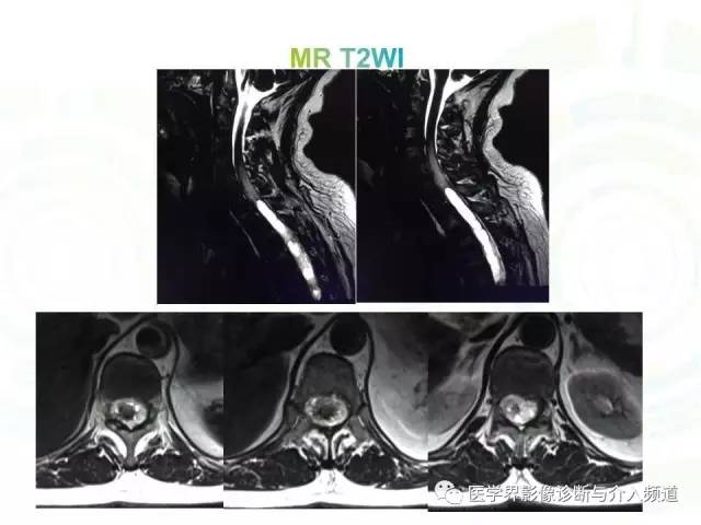 【病例】髓内星形细胞瘤1例MR影像表现