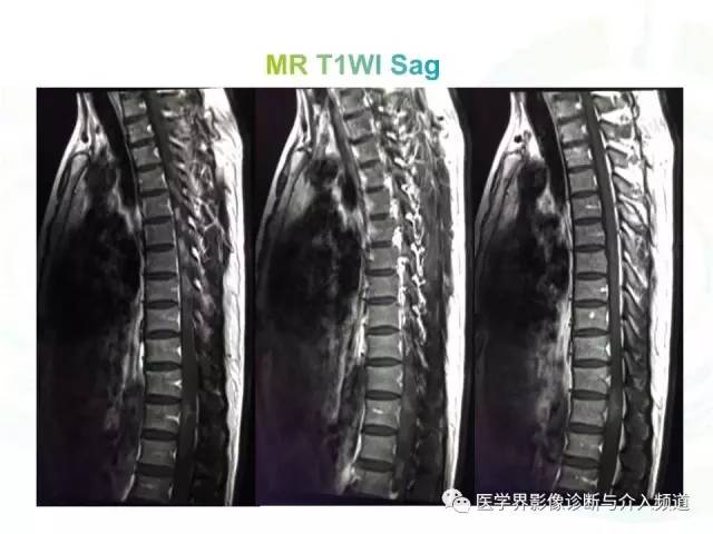 【病例】髓内星形细胞瘤1例MR影像表现