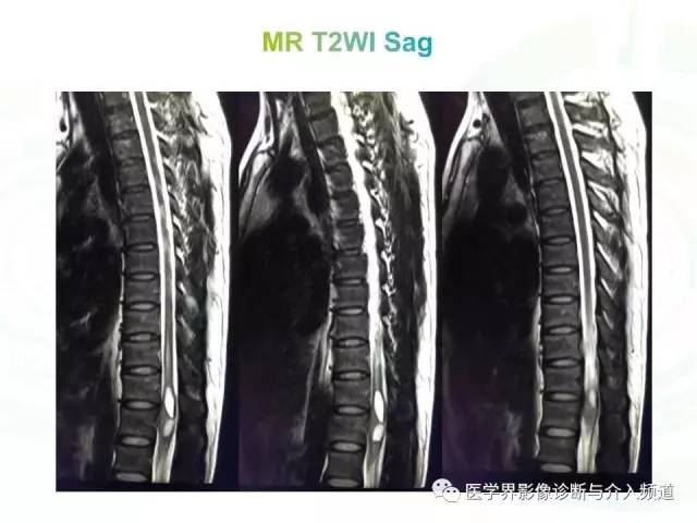 【病例】髓内星形细胞瘤1例MR影像表现