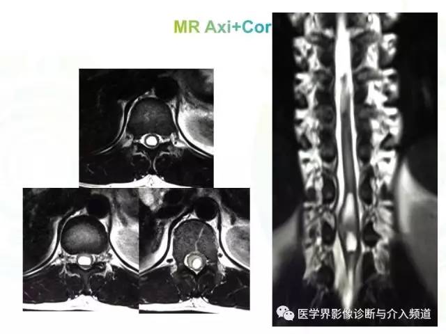 【病例】髓内星形细胞瘤1例MR影像表现