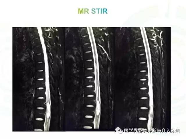 【病例】髓内星形细胞瘤1例MR影像表现