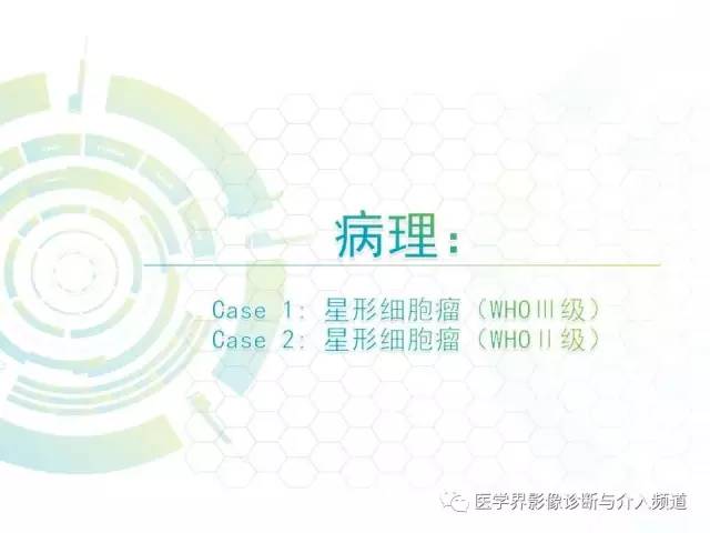 【病例】髓内星形细胞瘤1例MR影像表现