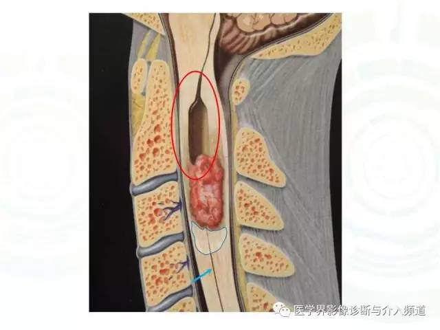 【病例】髓内星形细胞瘤1例MR影像表现