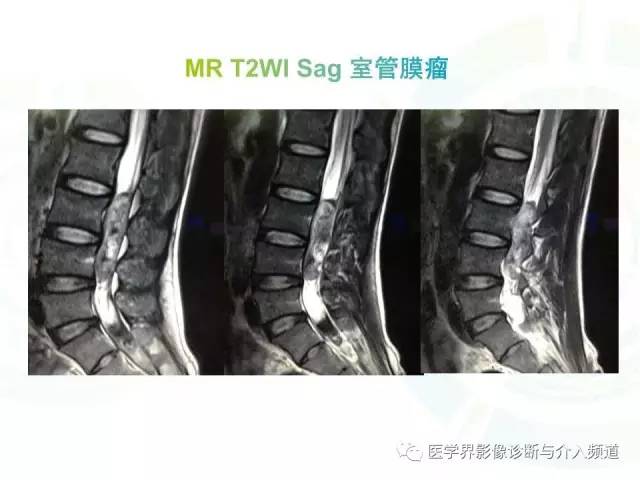 【病例】髓内星形细胞瘤1例MR影像表现