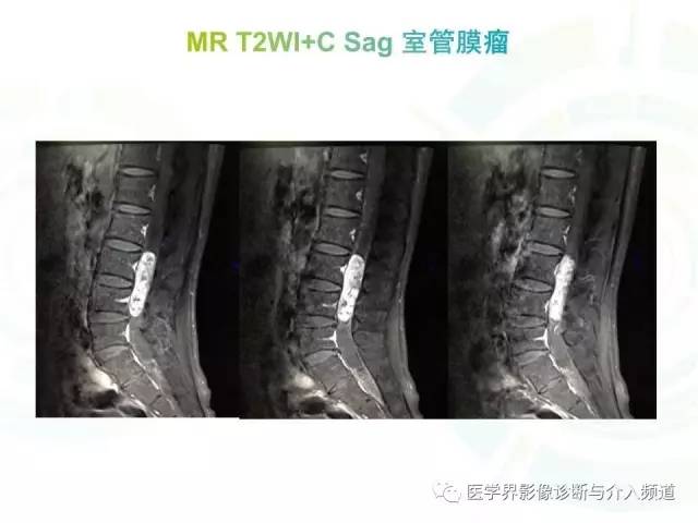 【病例】髓内星形细胞瘤1例MR影像表现