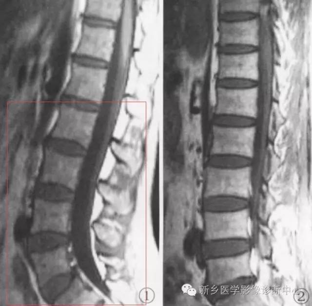 腰椎生理曲度变直的临床意义