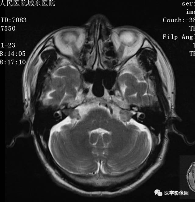 【病例】神经纤维瘤病NF2型一例MR