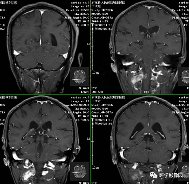 【病例】神经纤维瘤病NF2型一例MR 【病例】神经纤维瘤病NF2型一例MR