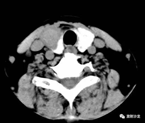 【病例】甲状腺癌1例CT影像表现 【病例】甲状腺癌1例CT影像表现