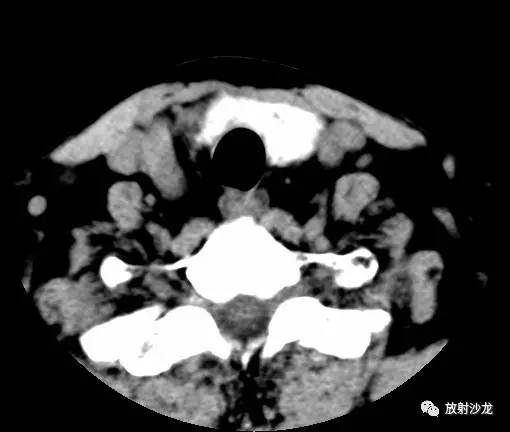 【病例】甲状腺癌1例CT影像表现 【病例】甲状腺癌1例CT影像表现