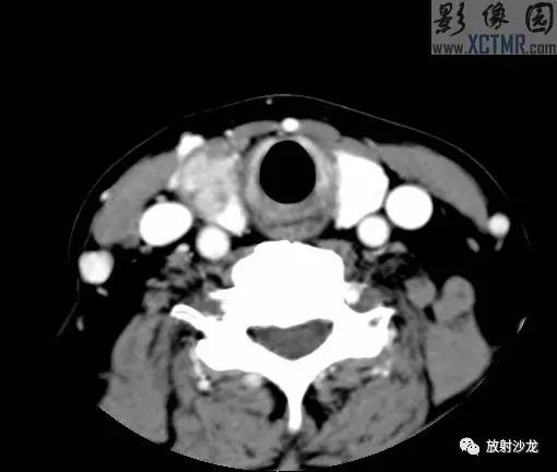 【病例】甲状腺癌1例CT影像表现 【病例】甲状腺癌1例CT影像表现